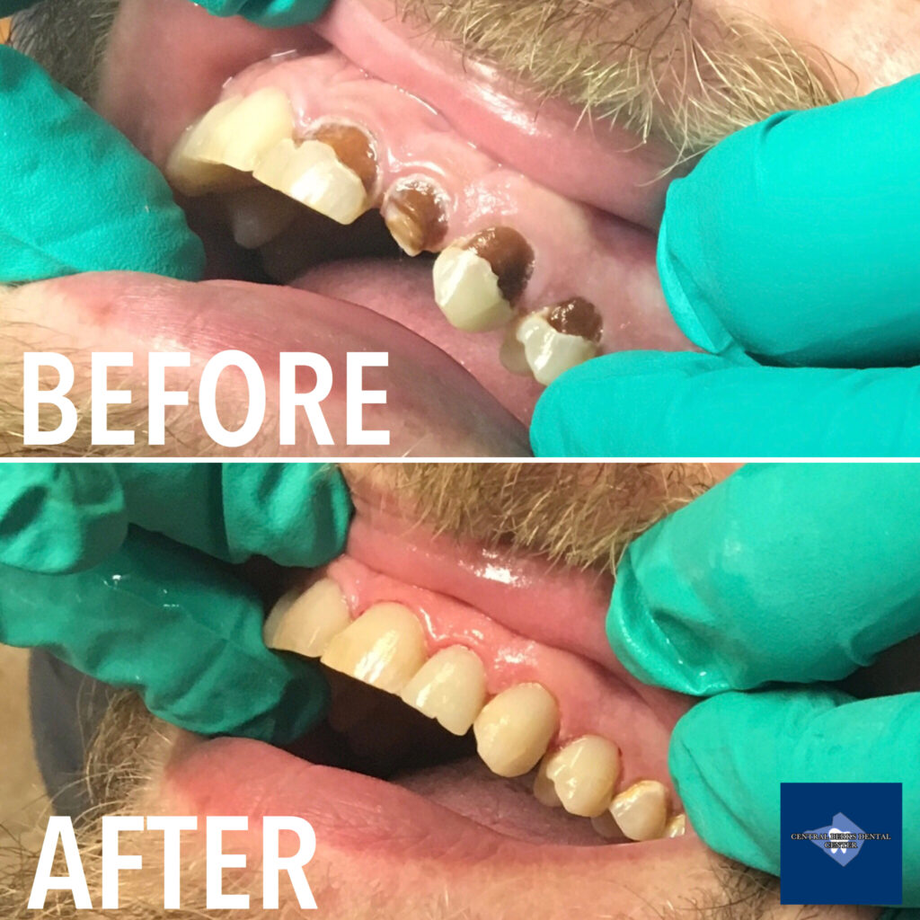 Dr. Steve made this patient’s day - WEDDING day, that is - when he bonded the decaying teeth prior to walking down the aisle! When our patients are happy, we are happy! 